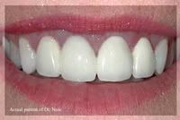 maui teeth whitening
